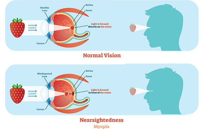 Protecting Your Precious Sight: Strategies to Prevent High Myopia